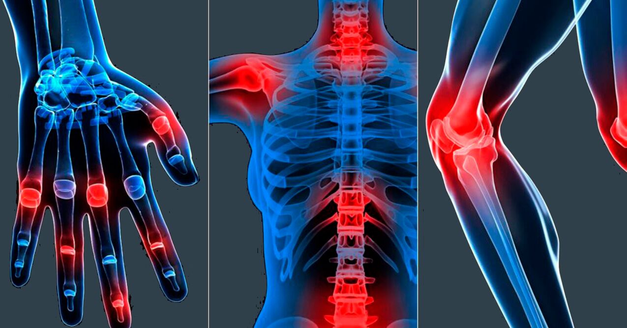 Ενδείξεις χρήσης εκχυλίσματος Boswellia σε κάψουλες