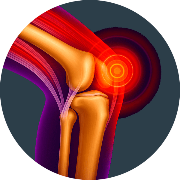 Φλεγμονή των αρθρώσεων